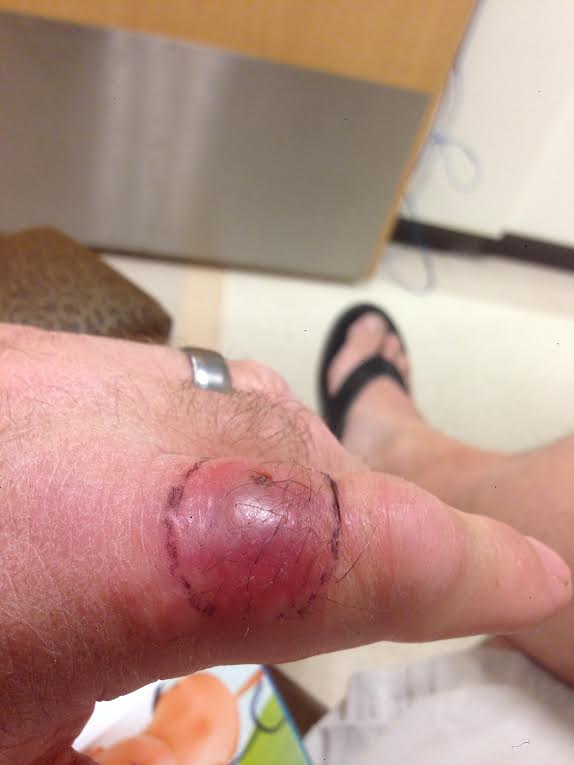 kellysmithblister1