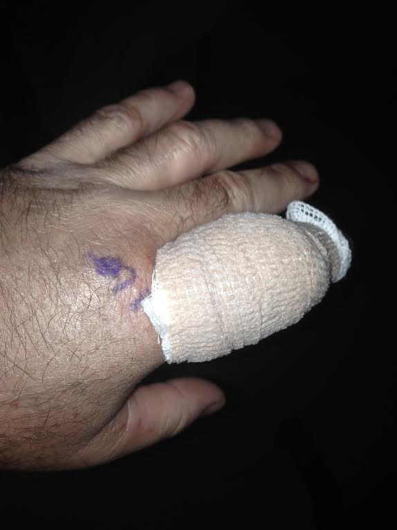 kellysmithblister2